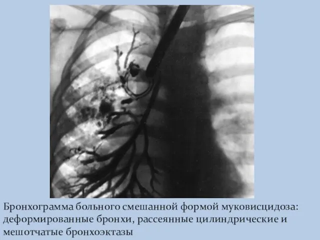 Бронхограмма больного смешанной формой муковисцидоза: деформированные бронхи, рассеянные цилиндрические и мешотчатые бронхоэктазы