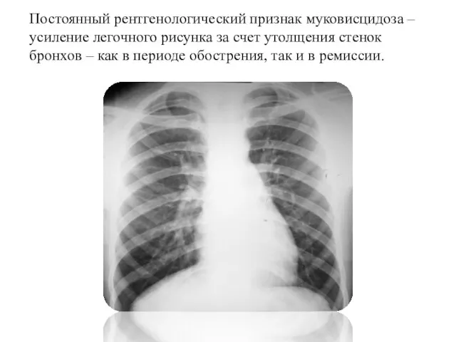 Постоянный рентгенологический признак муковисцидоза – усиление легочного рисунка за счет утолщения