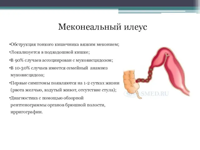 Обструкция тонкого кишечника вязким меконием; Локализуется в подвздошной кишке; В 90%