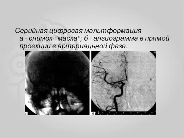 Серийная цифровая мальтформация а - снимок-"маска"; б - ангиограмма в прямой проекции в артериальной фазе.