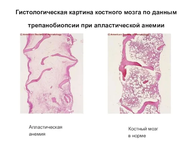 Гистологическая картина костного мозга по данным трепанобиопсии при апластической анемии Апластическая анемия Костный мозг в норме