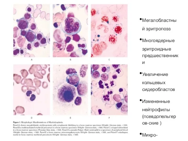 Мегалобластный эритропоэз Многоядерные эритроидные предшественники Увеличение кольцевых сидеробластов Измененные нейтрофилы (псевдопельгеров-ские ) Микро-мегакариоциты Уродливые эритроидные предшественники