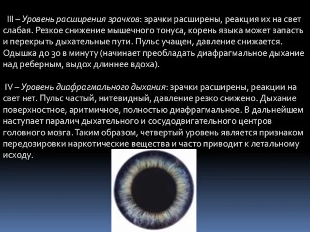 III – Уровень расширения зрачков: зрачки расширены, реакция их на свет