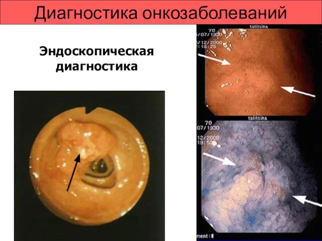 Диагностика онкозаболеваний Эндоскопическая диагностика