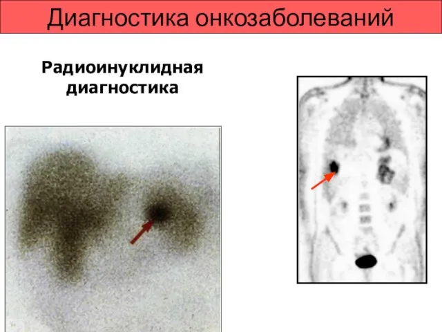 Диагностика онкозаболеваний Радиоинуклидная диагностика