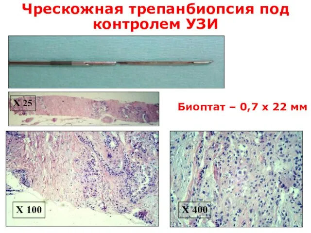 Чрескожная трепанбиопсия под контролем УЗИ Х 25 Х 100 Х 400