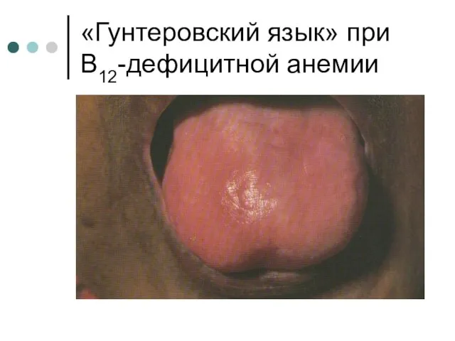 «Гунтеровский язык» при В12-дефицитной анемии