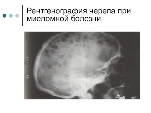 Рентгенография черепа при миеломной болезни