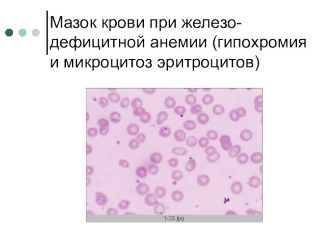 Мазок крови при железо-дефицитной анемии (гипохромия и микроцитоз эритроцитов)