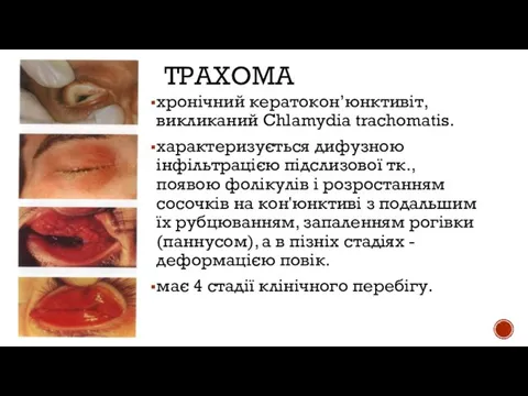 ТРАХОМА хронічний кератокон’юнктивіт,викликаний Chlamydia trachomatis. характеризується дифузною інфільтрацією підслизової тк.,появою фолікулів