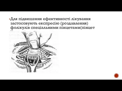 Для підвищення ефективності лікування застосовують експресію (роздавлення) фолікулів спеціальними пінцетами(пінцет Кнаппа).