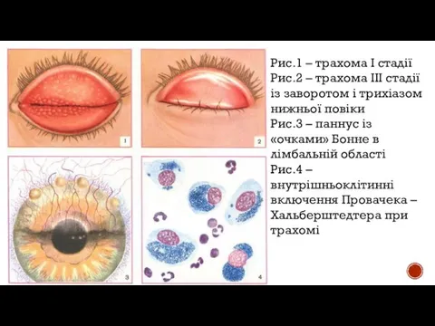 Рис.1 – трахома І стадії Рис.2 – трахома ІІІ стадії із