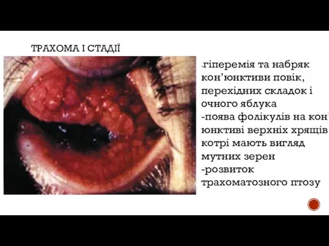 ТРАХОМА І СТАДІЇ -гіперемія та набряк кон’юнктиви повік,перехідних складок і очного