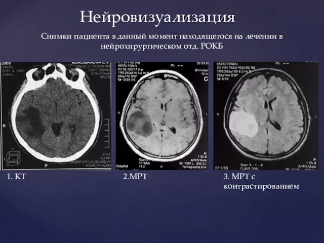 Нейровизуализация 1. КТ 2.МРТ 3. МРТ с контрастированием Снимки пациента в