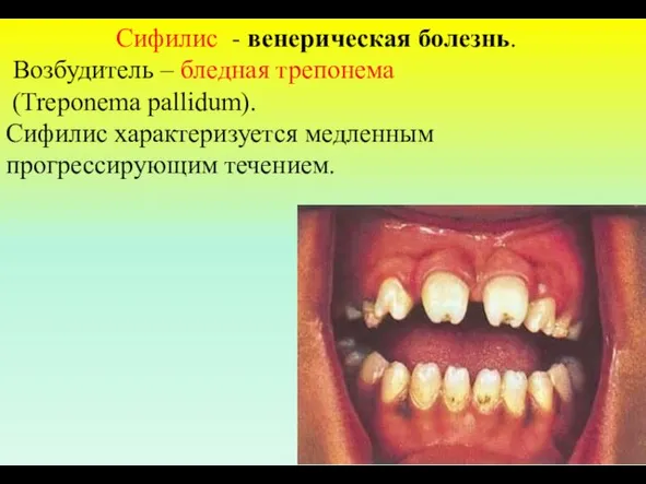 Сифилис - венерическая болезнь. Возбудитель – бледная трепонема (Treponema pallidum). Сифилис характеризуется медленным прогрессирующим течением.