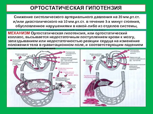 ОРТОСТАТИЧЕСКАЯ ГИПОТЕНЗИЯ Снижение систолического артериального давления на 20 мм.рт.ст. и/или диастолического