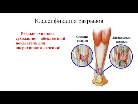 Классификация разрывов Разрыв ахиллова сухожилия – абсолютный показатель для оперативного лечения!