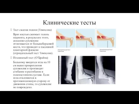 Клинические тесты Тест сжатия голени (Томпсона) Врач кистью сжимает голень пациента,