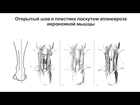 Открытый шов и пластика лоскутом апоневроза икроножной мышцы