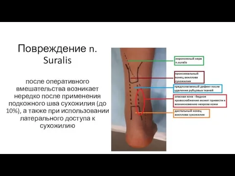 Повреждение n. Suralis после оперативного вмешательства возникает нередко после применения подкожного