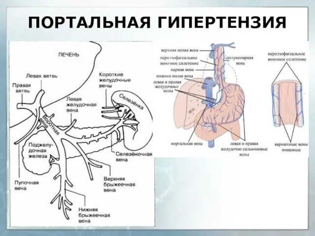 ПОРТАЛЬНАЯ ГИПЕРТЕНЗИЯ