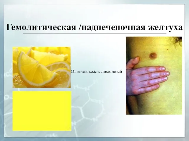 Гемолитическая /надпеченочная желтуха Оттенок кожи: лимонный