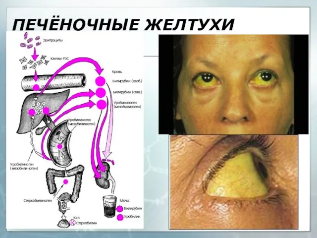 ПЕЧЁНОЧНЫЕ ЖЕЛТУХИ