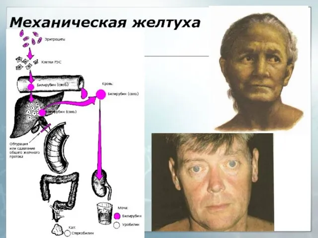 Механическая желтуха