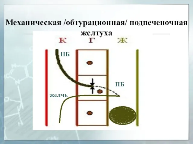 Механическая /обтурационная/ подпеченочная желтуха НБ ПБ желчь