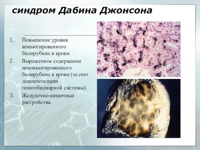 синдром Дабина Джонсона Повышение уровня коньюгированного билирубина в крови. Выраженное содержание