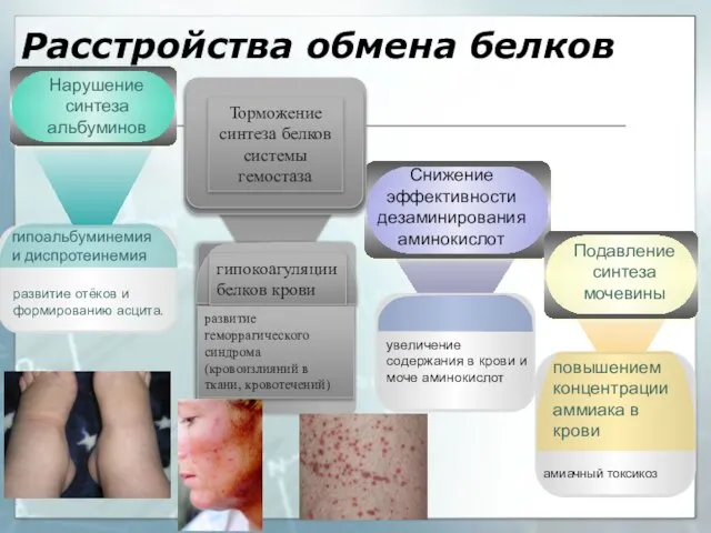 Расстройства обмена белков гипоальбуминемия и диспротеинемия развитие отёков и формированию асцита.