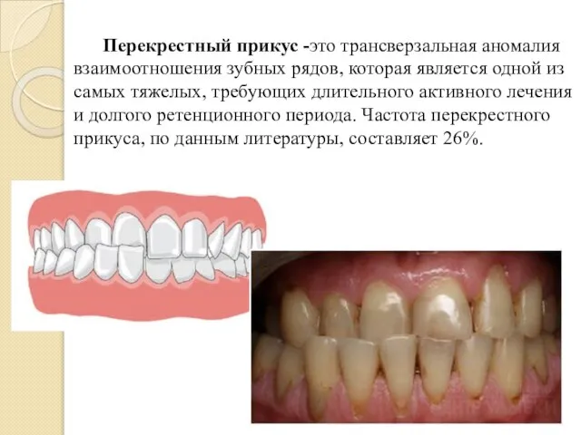 Перекрестный прикус -это трансверзальная аномалия взаимоотношения зубных рядов, которая является одной