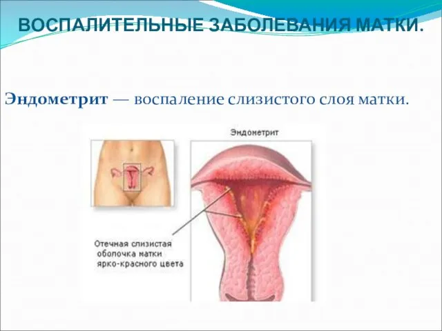 ВОСПАЛИТЕЛЬНЫЕ ЗАБОЛЕВАНИЯ МАТКИ. Эндометрит — воспаление слизистого слоя матки.