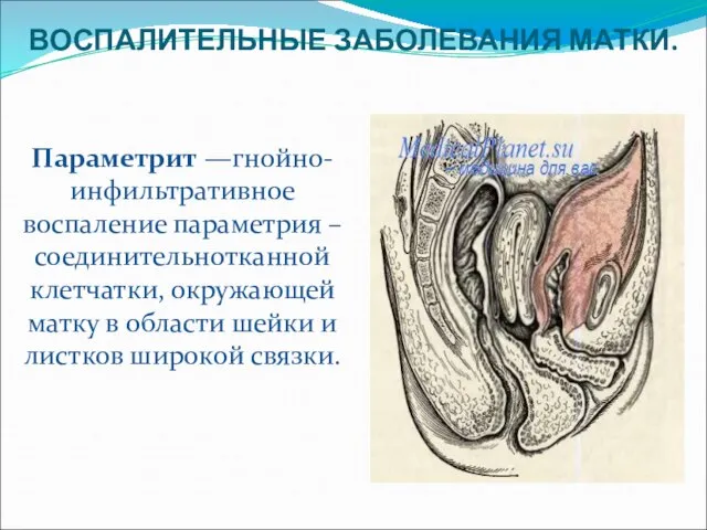 ВОСПАЛИТЕЛЬНЫЕ ЗАБОЛЕВАНИЯ МАТКИ. Параметрит —гнойно-инфильтративное воспаление параметрия – соединительнотканной клетчатки, окружающей