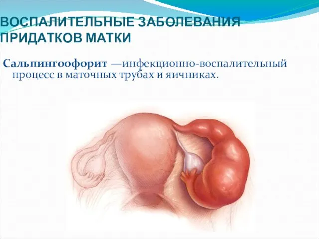 ВОСПАЛИТЕЛЬНЫЕ ЗАБОЛЕВАНИЯ ПРИДАТКОВ МАТКИ Сальпингоофорит —инфекционно-воспалительный процесс в маточных трубах и яичниках.