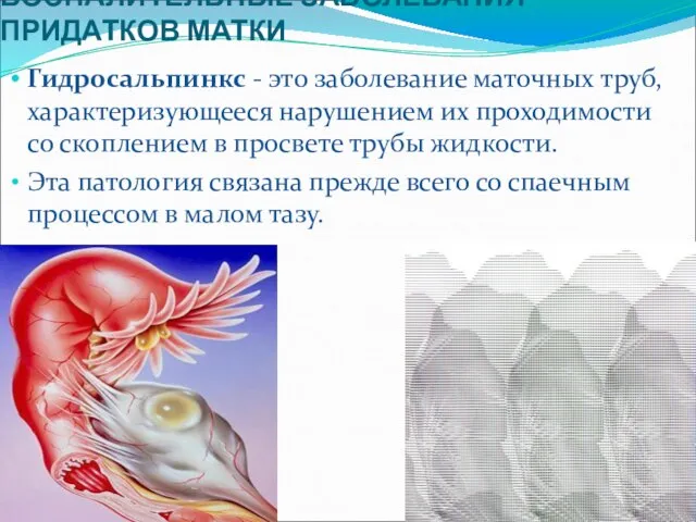 Гидросальпинкс - это заболевание маточных труб, характеризующееся нарушением их проходимости со