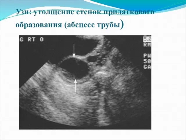 Узи: утолщение стенок придаткового образования (абсцесс трубы)