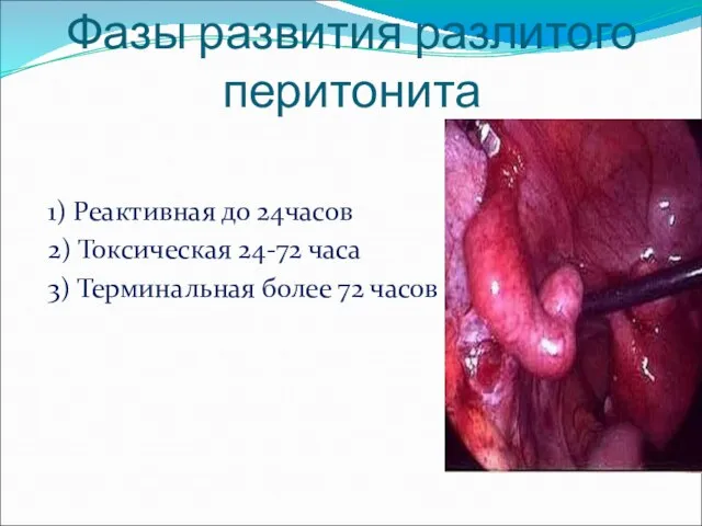 Фазы развития разлитого перитонита 1) Реактивная до 24часов 2) Токсическая 24-72