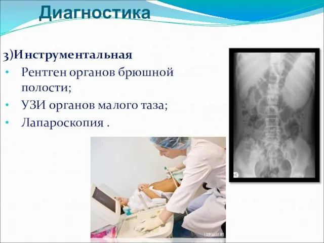 Диагностика 3)Инструментальная Рентген органов брюшной полости; УЗИ органов малого таза; Лапароскопия .