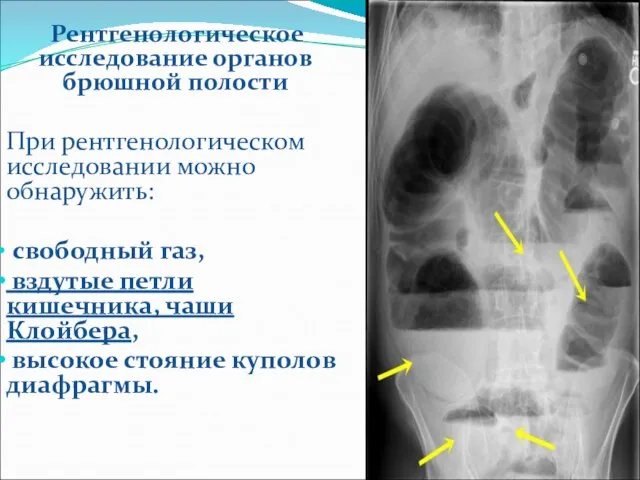 Рентгенологическое исследование органов брюшной полости При рентгенологическом исследовании можно обнаружить: свободный