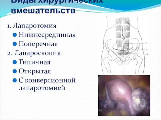 Виды хирургических вмешательств 1. Лапаротомия Нижнесрединная Поперечная 2. Лапароскопия Типичная Открытая С конверсионной лапаротомией