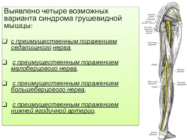 Выявлено четыре возможных варианта синдрома грушевидной мышцы: с преимущественным поражением седалищного