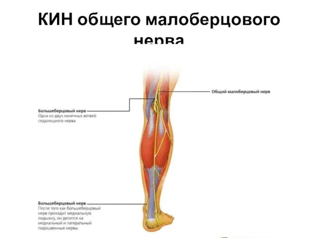 КИН общего малоберцового нерва синдром Гийена — Сеза — Де Блондена