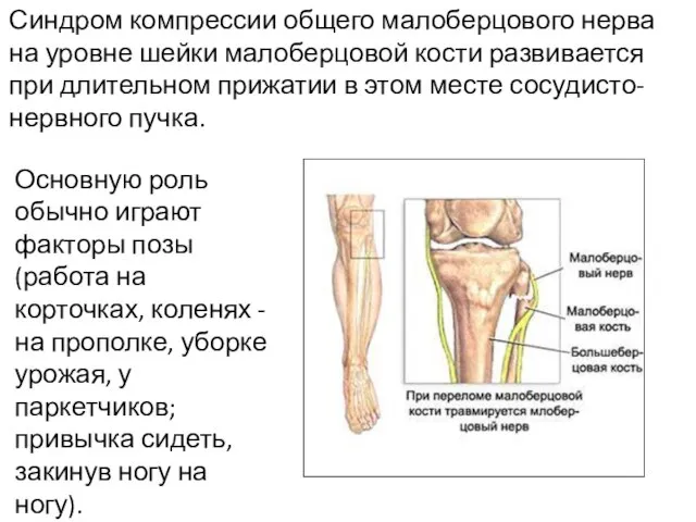 Синдром компрессии общего малоберцового нерва на уровне шейки малоберцовой кости развивается