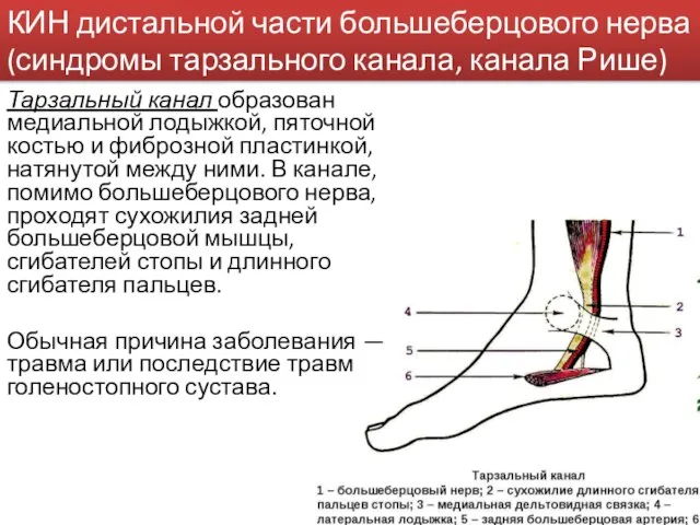 КИН дистальной части большеберцового нерва (синдромы тарзального канала, канала Рише) Тарзальный