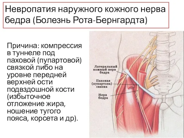 Невропатия наружного кожного нерва бедра (Болезнь Рота-Бернгардта) Причина: компрессия в туннеле