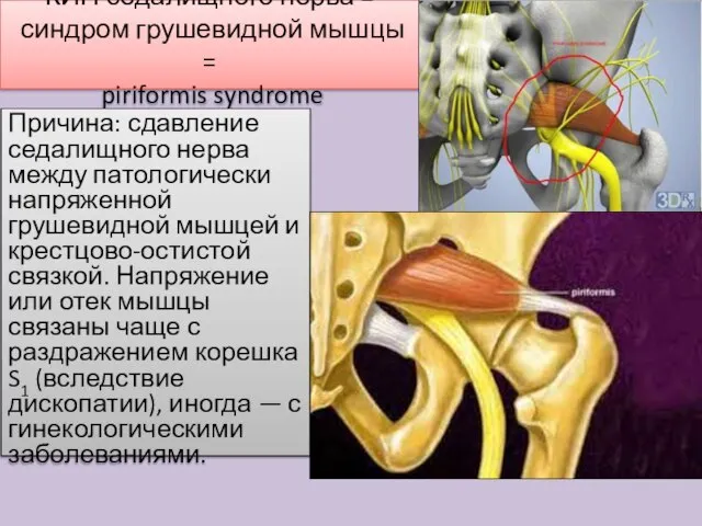 КИН седалищного нерва = синдром грушевидной мышцы = piriformis syndrome Причина: