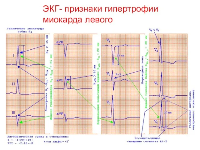 ЭКГ- признаки гипертрофии миокарда левого желудочка