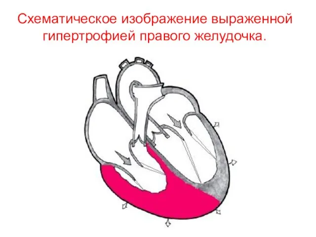 Схематическое изображение выраженной гипертрофией правого желудочка.