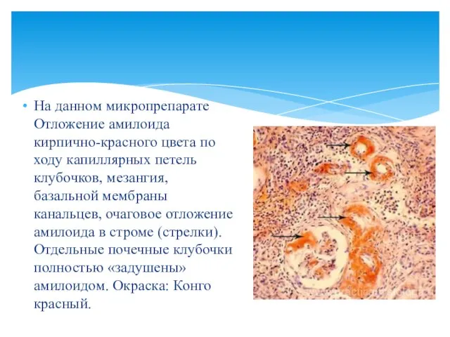 На данном микропрепарате Отложение амилоида кирпично-красного цвета по ходу капиллярных петель